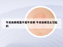 牛皮血癣疮是不是牛皮癣 牛皮血癣怎么引起的