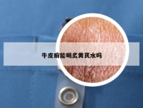 牛皮癣能喝炙黄芪水吗