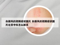 白巅风的初期症状图片 白巅风的初期症状图片北京中科怎么联系
