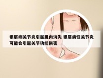 银屑病关节炎引起肌肉消失 银屑病性关节炎可能会引起关节功能损害