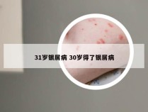 31岁银屑病 30岁得了银屑病