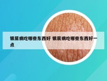 银屑病吃哪些东西好 银屑病吃哪些东西好一点