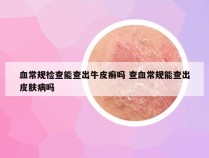 血常规检查能查出牛皮癣吗 查血常规能查出皮肤病吗