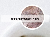 搜索郑州治牛皮癣最好的医院