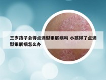 三岁孩子会得点滴型银屑病吗 小孩得了点滴型银屑病怎么办