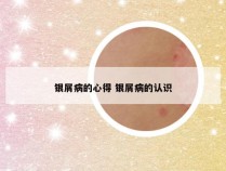银屑病的心得 银屑病的认识