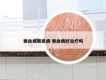 银血病银屑病 银血病好治疗吗