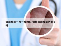 银屑病是一片一片的吗 银屑病成片是严重了吗