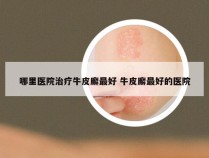 哪里医院治疗牛皮廨最好 牛皮廨最好的医院