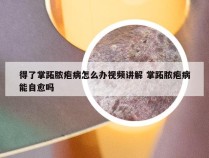 得了掌跖脓疱病怎么办视频讲解 掌跖脓疱病能自愈吗