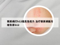 银屑病打b12提高免疫力 治疗银屑病偏方维生素b12