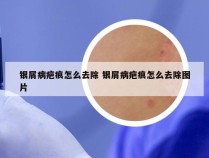 银屑病疤痕怎么去除 银屑病疤痕怎么去除图片