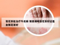菊花茶能治疗牛皮癣 银屑病喝菊花茶好还是金银花茶好