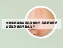 点滴状银屑病会引起发低烧吗 点滴状银屑病会引起发低烧吗怎么治疗