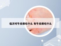 临沂对牛皮癣吃什么 有牛皮癣吃什么