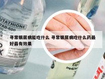 寻常银屑病能吃什么 寻常银屑病吃什么药最好最有效果
