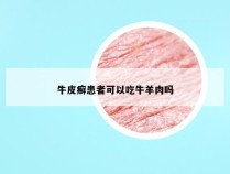 牛皮癣患者可以吃牛羊肉吗