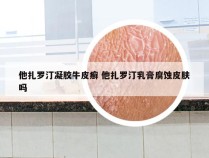 他扎罗汀凝胶牛皮癣 他扎罗汀乳膏腐蚀皮肤吗