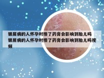 银屑病的人怀孕时擦了药膏会影响到胎儿吗 银屑病的人怀孕时擦了药膏会影响到胎儿吗视频