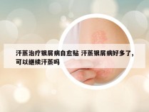 汗蒸治疗银屑病自愈贴 汗蒸银屑病好多了,可以继续汗蒸吗