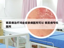 银屑病治疗鸿业皮肤病医院可以 银屑病专科医院