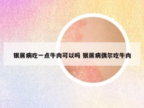 银屑病吃一点牛肉可以吗 银屑病偶尔吃牛肉
