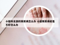 小腿和足部的银屑病怎么办 小腿银屑病老是不好怎么办