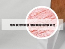 银屑病好转症状 银屑病好转症状表现