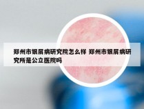 郑州市银屑病研究院怎么样 郑州市银屑病研究所是公立医院吗