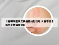 长春哪家医院皮肤病看的比较好 长春市哪个医院皮肤病看得好