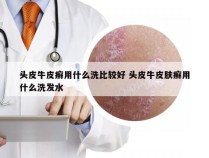 头皮牛皮癣用什么洗比较好 头皮牛皮肤癣用什么洗发水