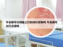 牛皮癣可以到腿上打封闭针控制吗 牛皮癣可以打点滴吗