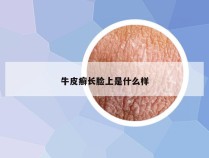 牛皮癣长脸上是什么样