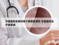 华西医院皮肤科哪个看银屑病性 华西医院治疗银屑病