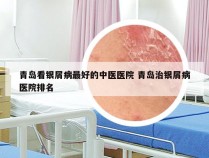 青岛看银屑病最好的中医医院 青岛治银屑病医院排名