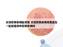 点滴型银屑病起疙瘩 点滴型银屑病疙瘩连在一起就是斑块型银屑病吗