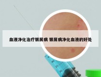 血液净化治疗银屑病 银屑病净化血液的好处