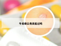 牛皮癣公务员能过吗