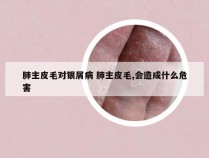肺主皮毛对银屑病 肺主皮毛,会造成什么危害