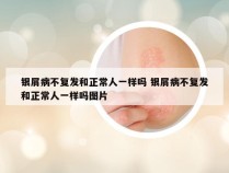 银屑病不复发和正常人一样吗 银屑病不复发和正常人一样吗图片