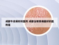 成都牛皮癣好的医院 成都治银屑病最好的医院是