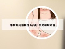 牛皮癣药浴用什么药好 牛皮顽癣药浴
