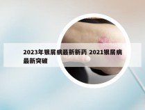 2023年银屑病最新新药 2021银屑病最新突破