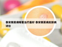 泰安银屑病哪里治疗最好 泰安银屑病皮肤病评价