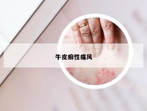 牛皮癣性痛风