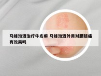 马蜂泡酒治疗牛皮癣 马蜂泡酒外用对腰腿痛有效果吗