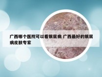 广西哪个医院可以看银屑病 广西最好的银屑病皮肤专家