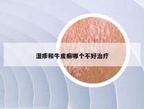 湿疹和牛皮癣哪个不好治疗