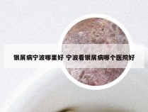 银屑病宁波哪里好 宁波看银屑病哪个医院好