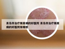 青岛市治疗银屑病的好医院 青岛市治疗银屑病的好医院有哪些